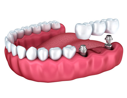 Dental Crowns and Bridges