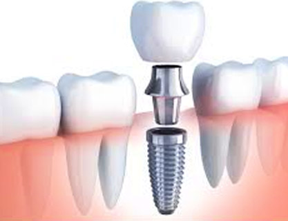 DENTAL IMPLANTS
