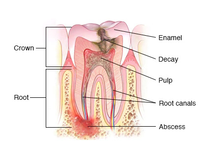 root canal treatment