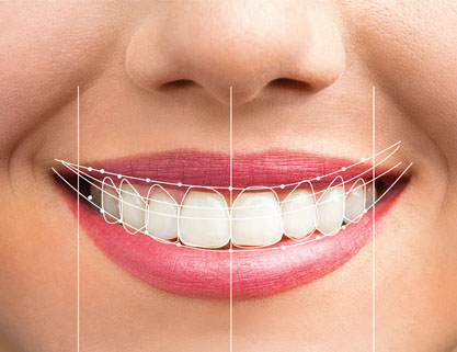 smile designing