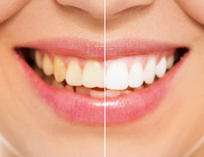 TEETH WHITENING