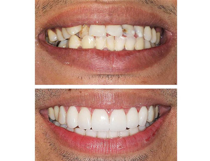 veneers